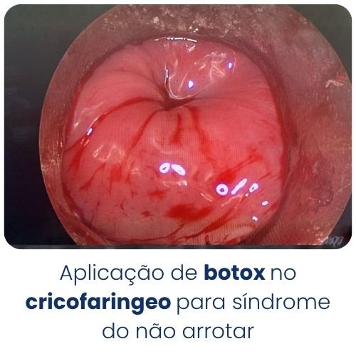Aplicação de botox no cricofaringeo para síndrome do não arrotar